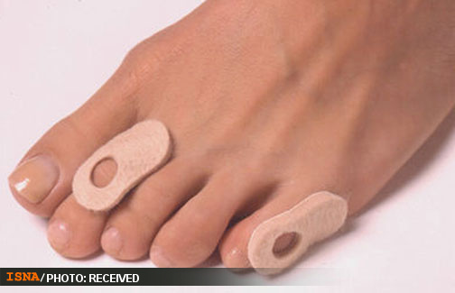 سنگپا، درمانی برای میخچه سنگپا، درمانی برای میخچه