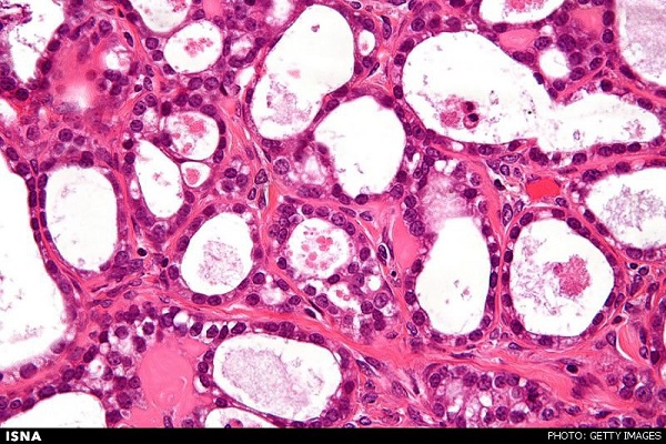 تکثیر سرطان با چاپ سه بعدی! تکثیر سرطان با چاپ سه بعدی!