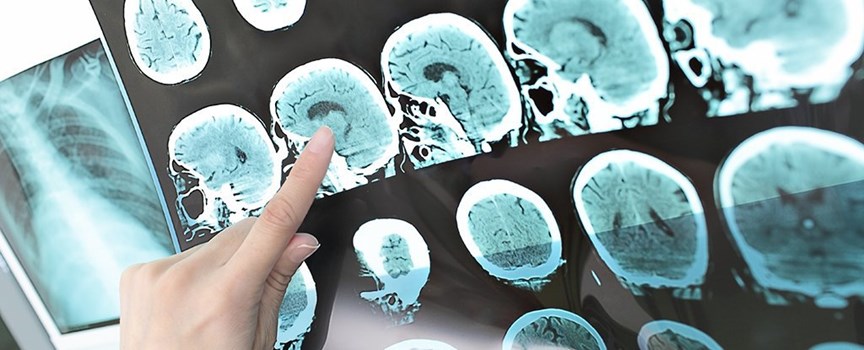 کشف یک روش درمانی جدیدی برای بیماری MS کشف یک روش درمانی جدیدی برای بیماری MS