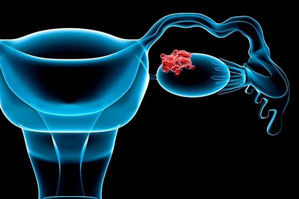 از نشانه&zwnj;های ظریف سرطان تخمدان که شاید نادیده گرفته شوند