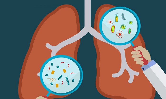 5 دلیل اصلی ابتلا به ذات الریه و چگونگی پیشگیری از آن 5 دلیل اصلی ابتلا به ذات الریه و چگونگی پیشگیری از آن