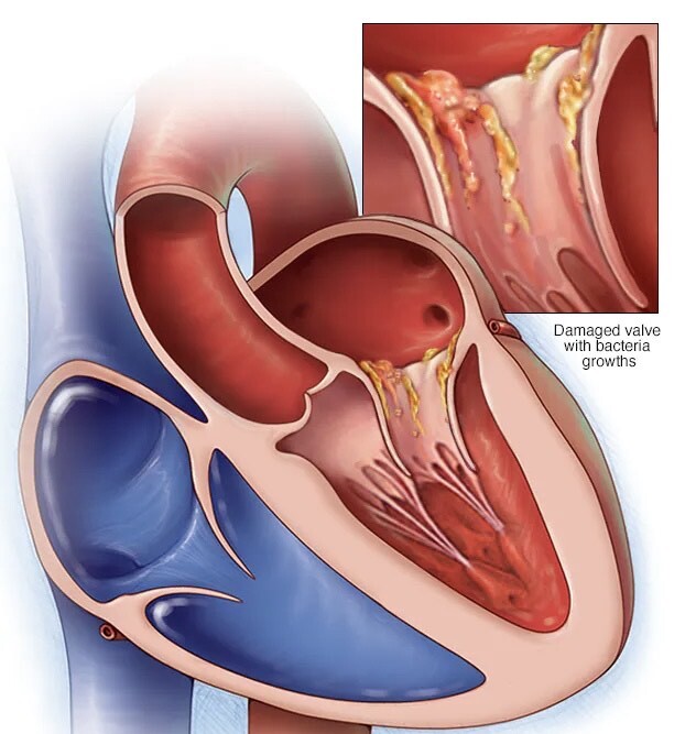 هر آنچه باید در مورد اندوکاردیت بدانیم